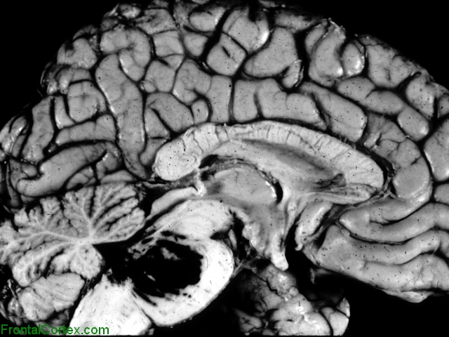 Pontine Hemorrhage, sagittal section of brain